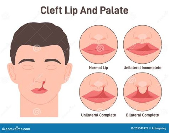 Unmasking Beauty: Celebrities with Cleft Lip